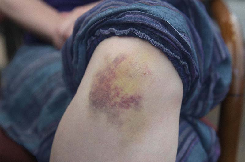 How to Manage Pain, Swelling, and Bruising After a Sports Injury best sports injury doctor in Kothrud and bavdhan