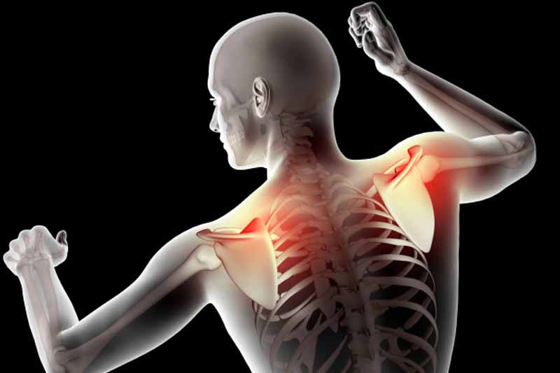 Is a Pinched Nerve Causing Your Shoulder Pain? Best Shoulder Pain Treatment in Kothrud & Bavdhan