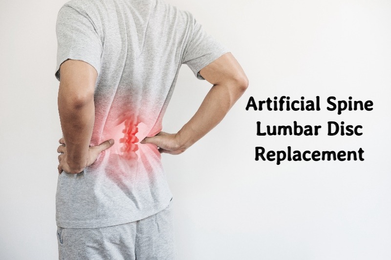 Artificial spine Lumbar Disc Replacement