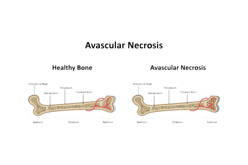 Best Clinic to cure Avascular Necrosis in Pune - Chirayu Clinic Kothrud