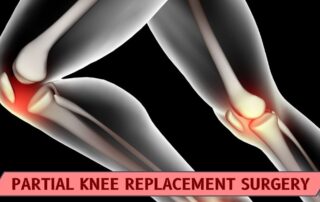 Partial knee replacement surgery at chirayu clinic