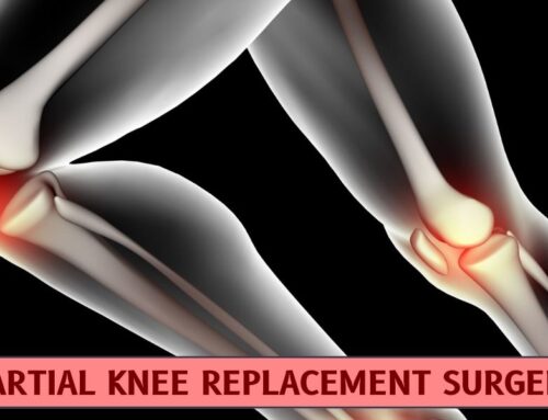 Who Requires Partial Knee Replacement Surgery ?