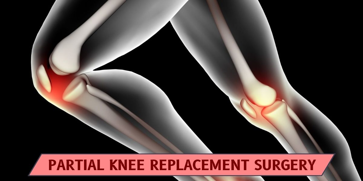 Who Requires Partial Knee Replacement Surgery ? Dr. Vinil Shinde