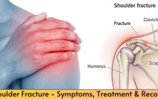 Shoulder fracture - Anatomy